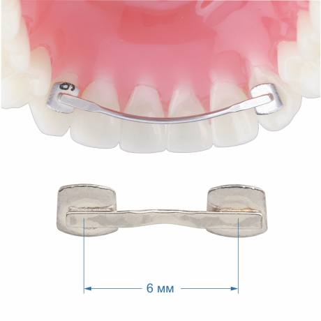 Лингвальный ретейнер (1х1) 6 мм