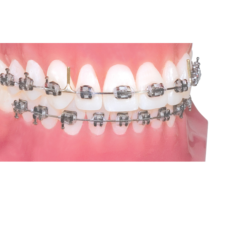 Дуга стальная ТруФорс, форма Полноразмерная 16х22 с 2 штангами 40