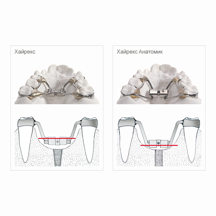 Небный винт Хайрекс Анатомик малый